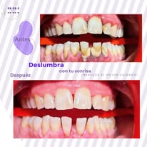 Caso clínico Innovo Smiles antes y después 1