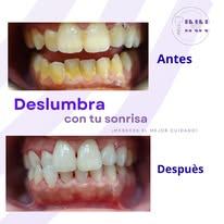 Caso clínico Innovo Smiles antes y después 2