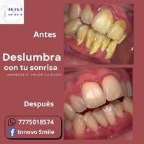 Caso clínico Innovo Smiles antes y después 3